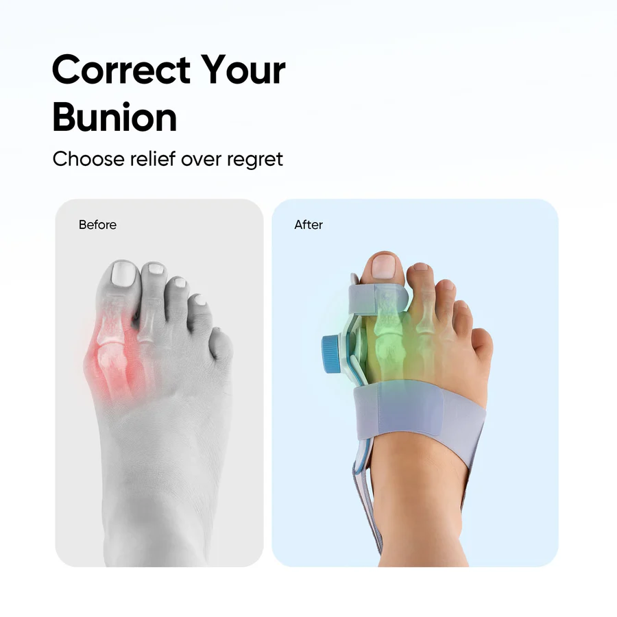 Frido Orthotics Bunion Corrector - Image 2